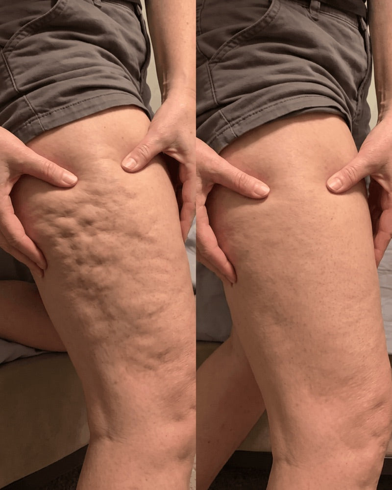 Customer photo: thigh, before and after