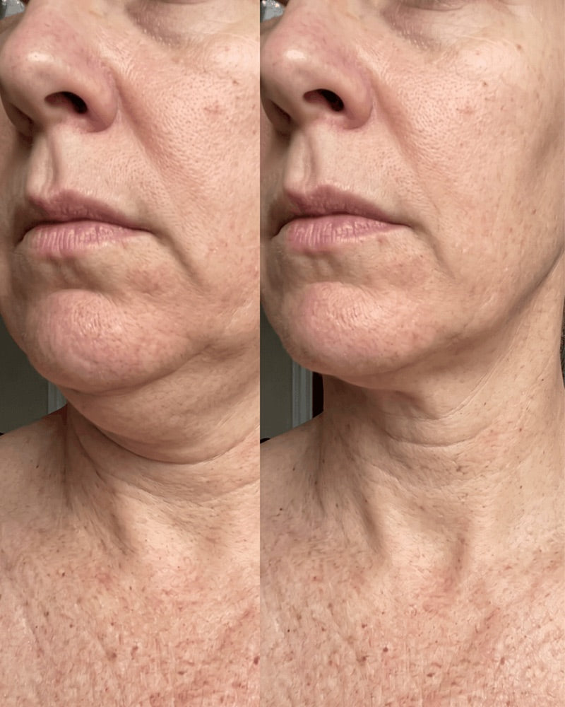 Customer photo: jawline and neck, before and after