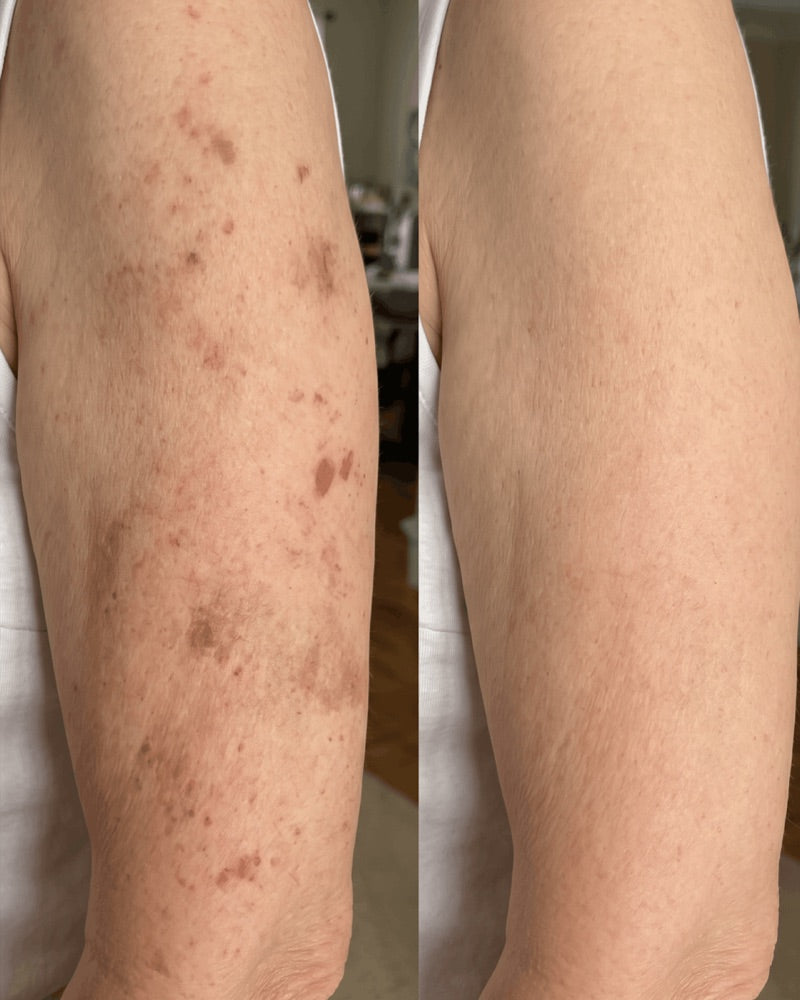 Customer photo: upper arm, before and after